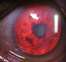 Anterior subcapsular cataract