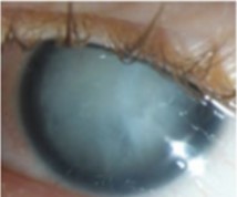 Mature Aniridia Eye